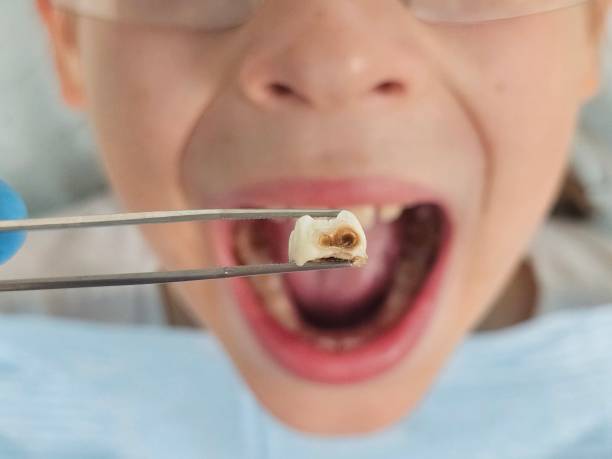 Best Urgent Care for Lost Fillings or Crowns in North Eastham, MA